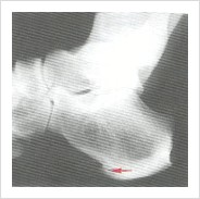 종골 가시 X-ray 사진