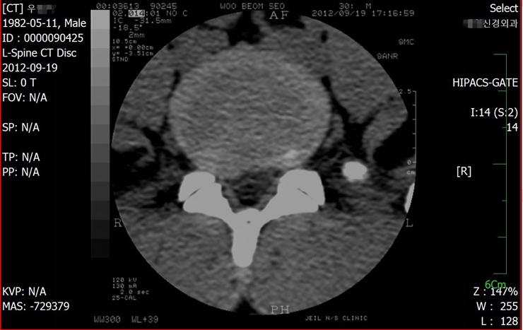 WOOBS-M31-Lumbar-HIVD-CT