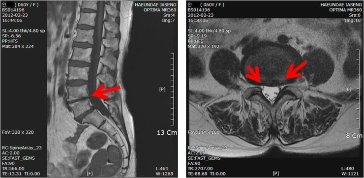 AhnJS_stenosis MRI