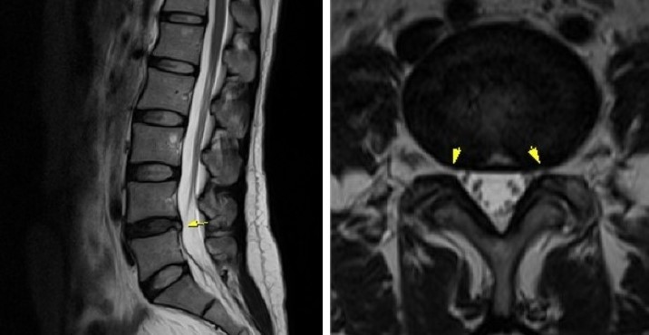 요추 4-5번 중심형 디스크 탈출증 MRI